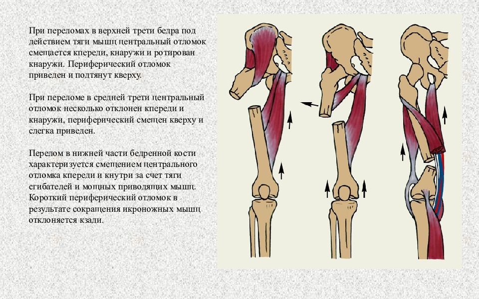 Переломы верхней конечности презентация