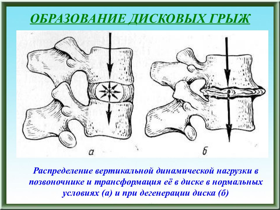 Жировая дегенерация позвоночника