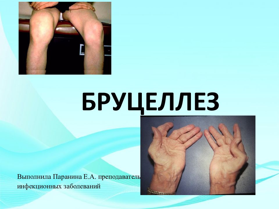 БРУЦЕЛЛЕЗ