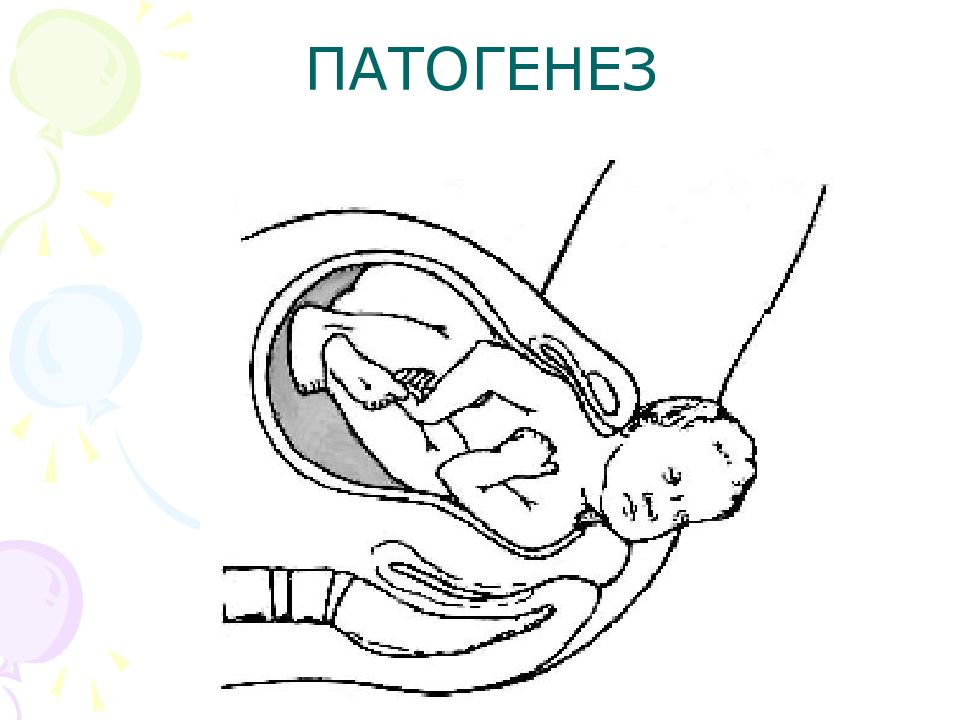 Дистоция плечиков презентация