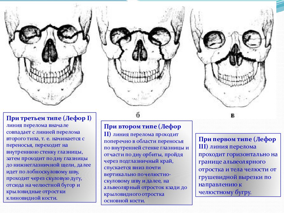 Переломы костей верхней челюсти. Перелом челюсти по Лефор 1. Лефор переломы верхней челюсти. Перелом верхней челюсти по Лефору. Перелом верхней челюсти по Лефору 1.