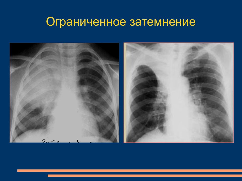 Симптомы затемнения легких. Ограниченное затемнение заболевания. Ограниченные затемнения. Лучевая диагностика.