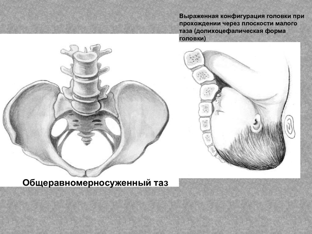 Гинекоидный таз. Аномалии костного таза. Аномальные формы таза. Формы сужения таза. Аномалии костного таза Акушерство.