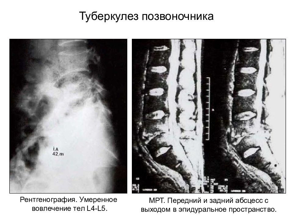 Туберкулез позвоночника презентация