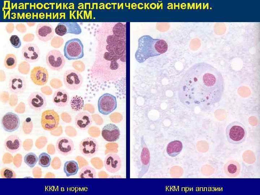 Анемия картина. Костный мозг при апластической анемии. Картина крови апластической анемии. Гипопластическая анемия мазок крови. Апластические анемии мазок крови.