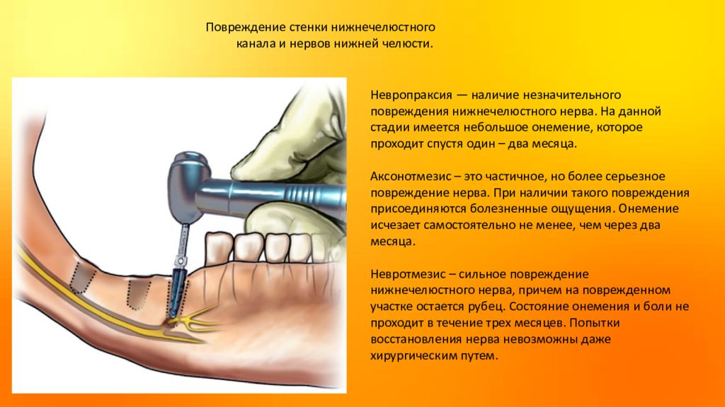 Повреждение стенок. Расстояние между имплантом и нижнечелюстным каналом. Кутанеостома возможные осложнения. Возможные осложнения от шеечных колпачков. Имплантация и инокуляция.