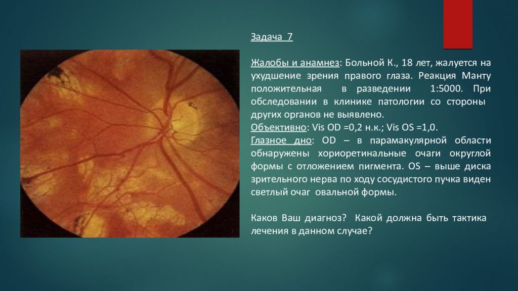 Сужение сосудов глаз. Нанофтальм глазное дно. Офтальмоскопическая картина глазного дна. Исследование глазного дна в неврологии. Поврежденное глазное дно.