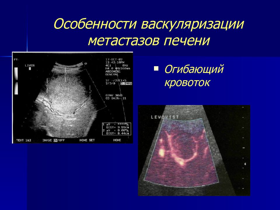 Метастазы в печени на узи. Метастазы в печень гиперэхогенные УЗИ. Очаговое поражение печени на УЗИ. Очаговые образования в печени на УЗИ.