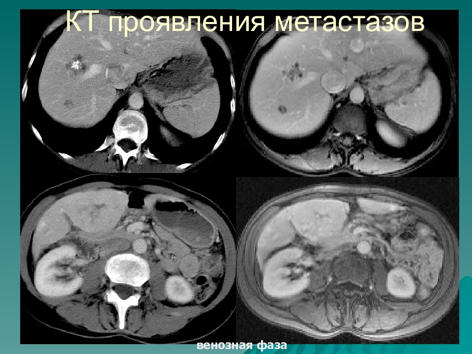 Мрт симптомы
