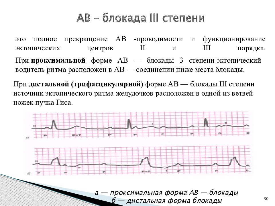 Ав блокада степени. Атриовентрикулярная блокада 3 степени на ЭКГ. Полная АВ блокада 3 степени ЭКГ. АВ блокада 3 степени заключение ЭКГ. АВ блокада 3 ст на ЭКГ.