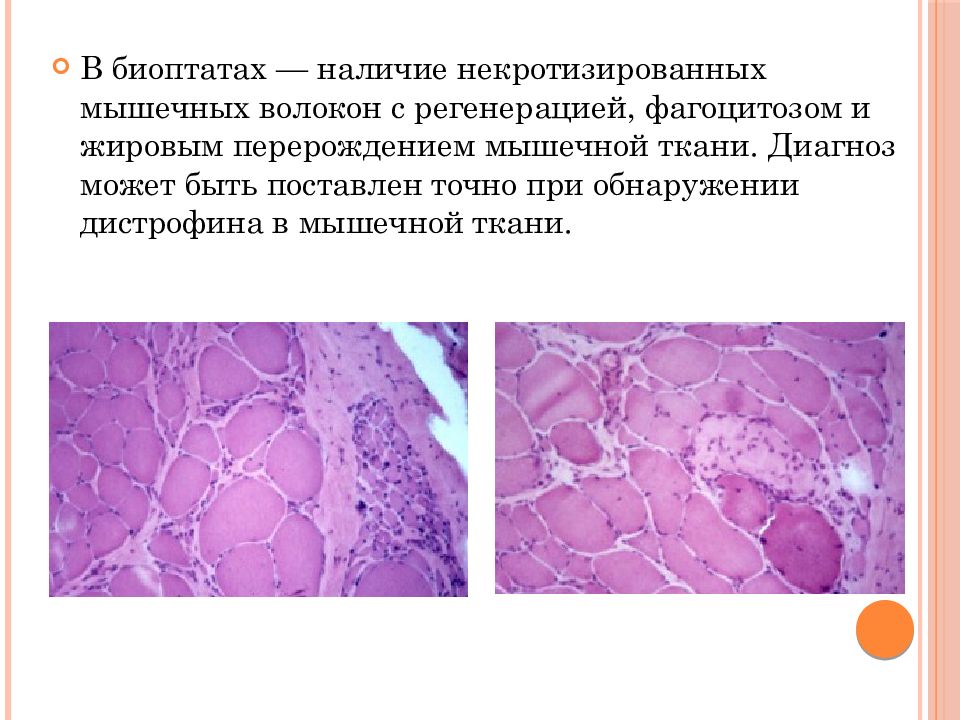 Прогрессирующие мышечные дистрофии презентация