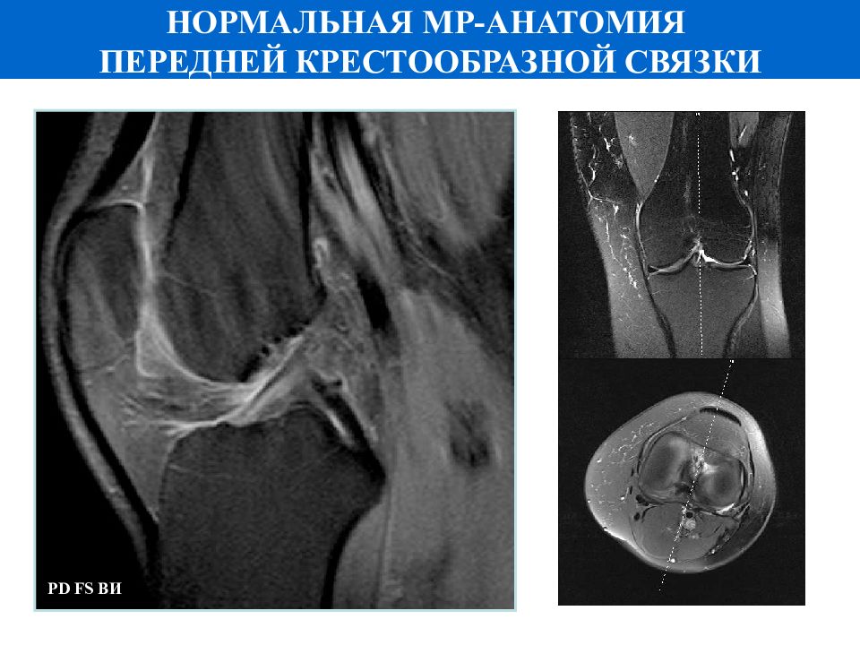 Мукоидная дегенерация крестообразной связки