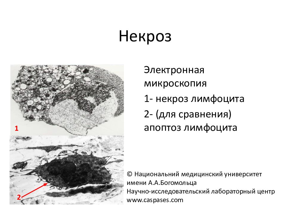 Стадии некроза. Колликвационный некроз микроскопия. Некроз электронная микрофотография. Некроз электронная микроскопия. Микроскопический некроз.