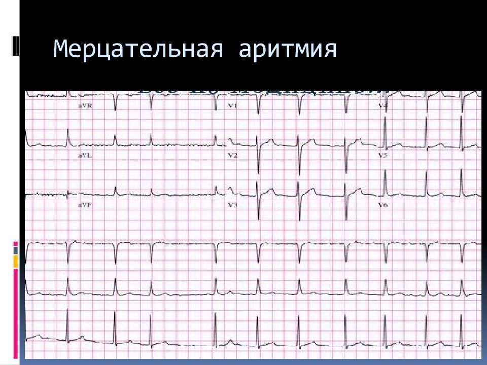 Аритмия на экг. Мерцательная аритмия на ЭКГ. Мерцательная ар тмия Экн. Мерцательная аритмия кардиограмма. ЭКГ при мерцательной аритмии.