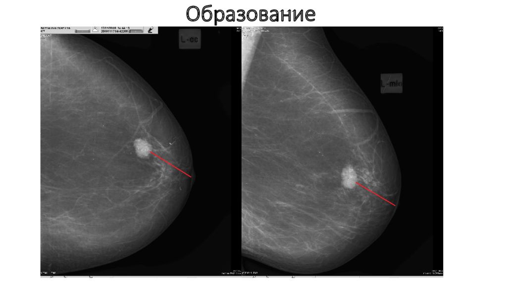 Маммография уплотнения. Маммография. Маммография молочных желез. Снимок маммографии молочных желез. Онкология на маммографии.