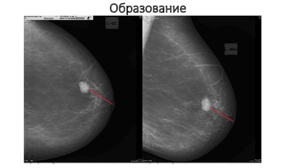 Маммография молочных желез вред