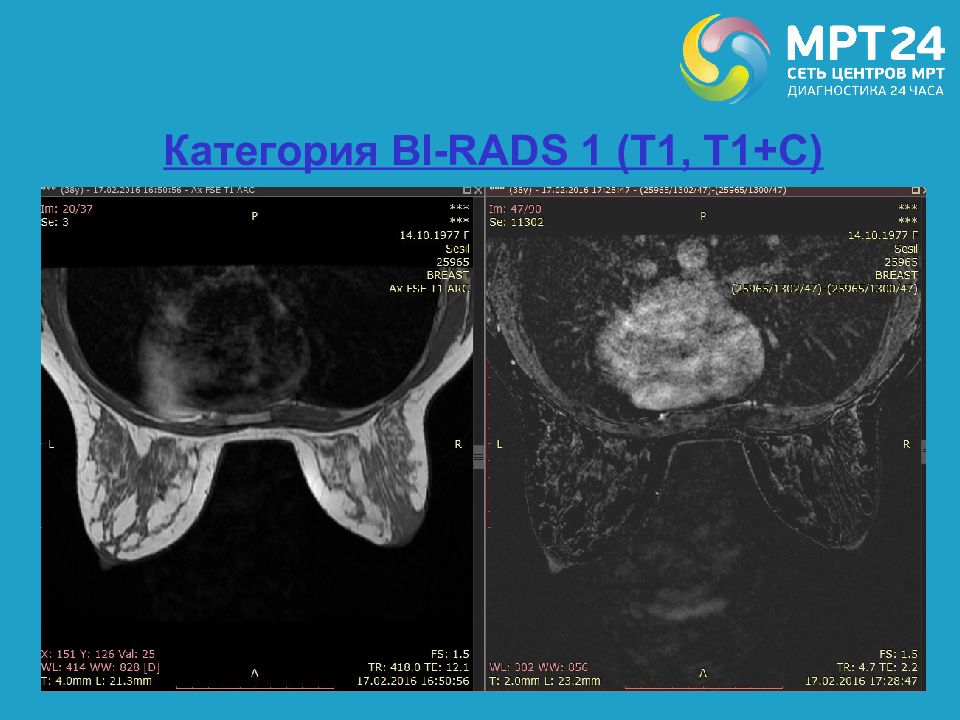 G rads. Категория bi-rads. Bi rads 1. Мрт молочных желез bi-rads. Категории birads.