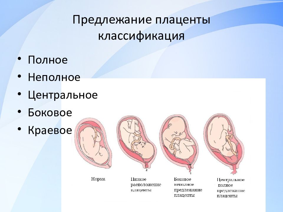 Полное предлежание хориона