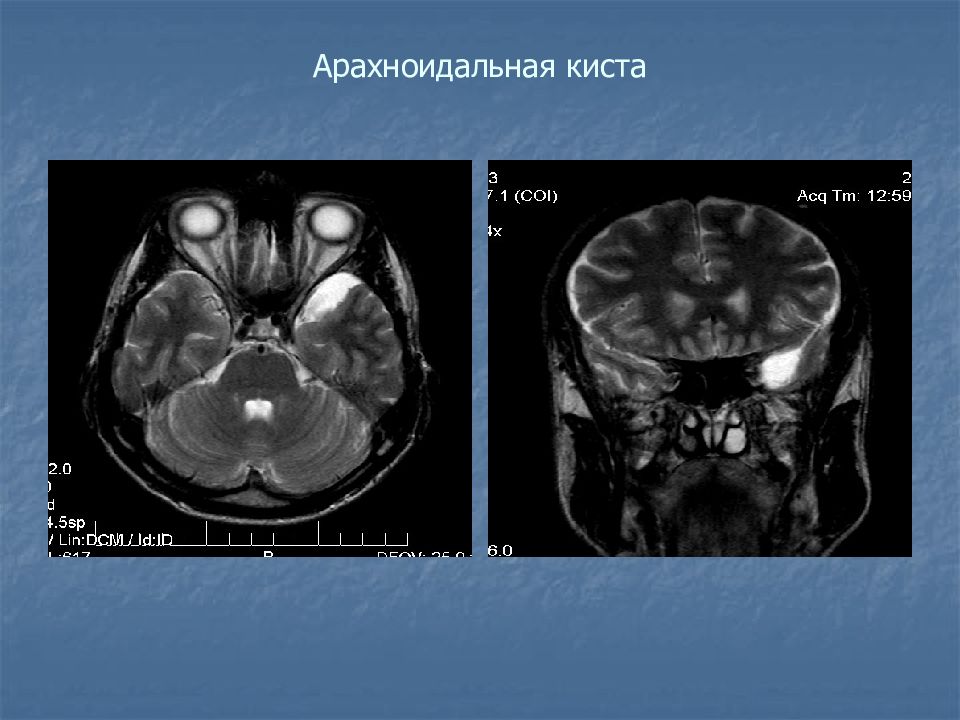 Картина ретроцеребеллярной кисты