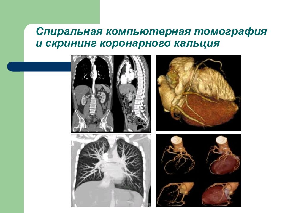 Кт скрининг коронарного кальция