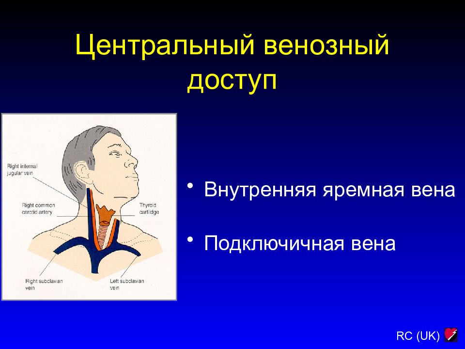 Центральных венах. Яремная и подключичная Вена. Центральный венозный доступ. Центральный венозный катетер яремная Вена. Центральная катетеризация внутренней яремной вены.