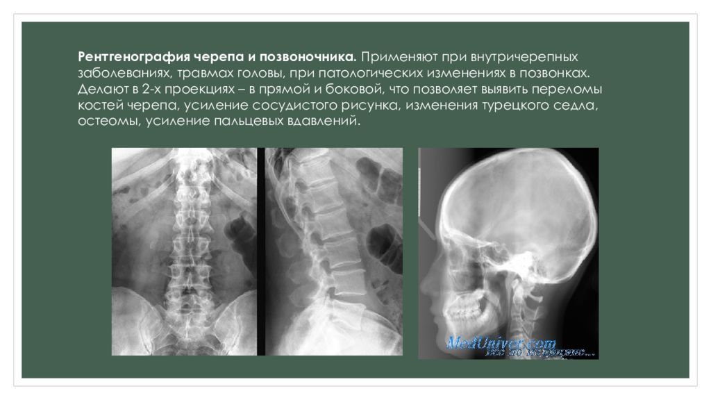 Рентген черепа в 2 х проекциях