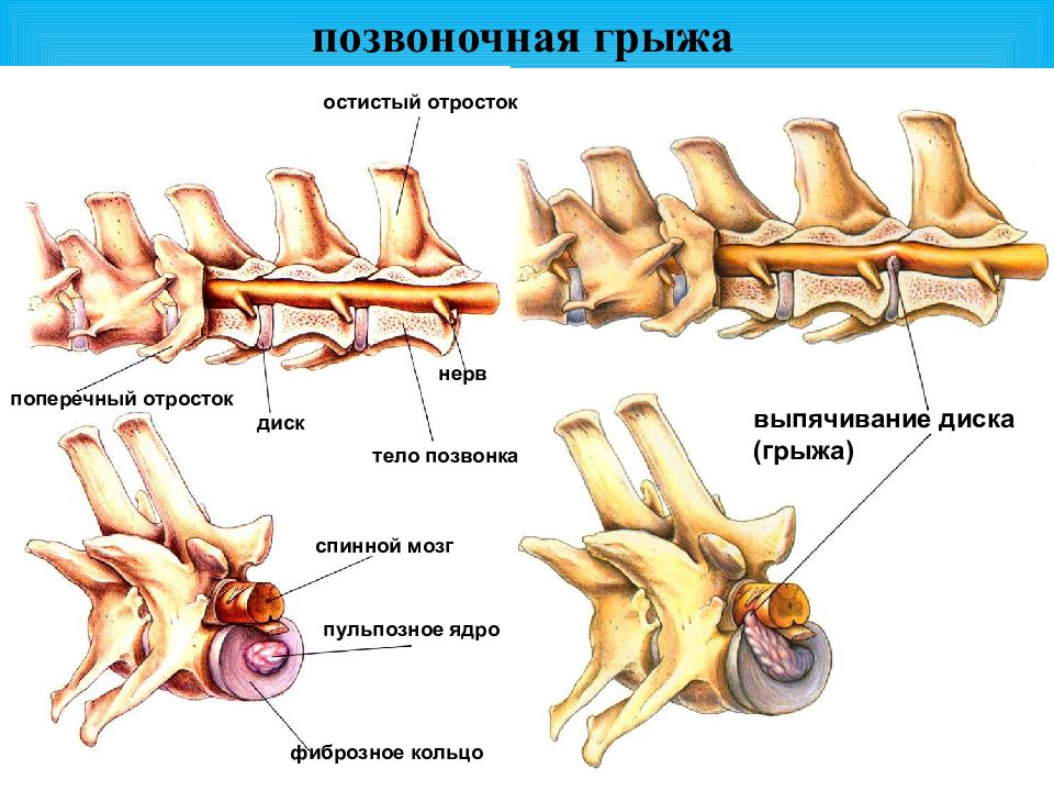 Соединения позвоночника. Соединение костей синдесмология. Выпячивание остистого отростка. Соединение поперечных отростков. Синдесмология позвоночного.