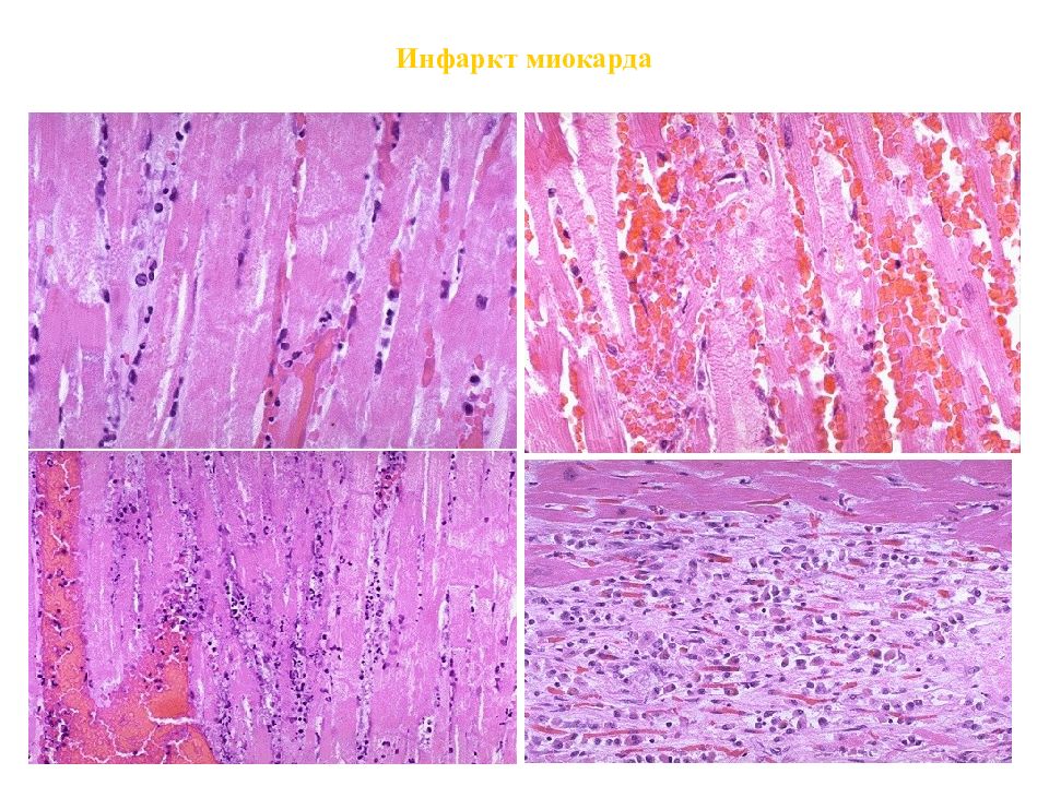 Кардиосклероз рисунок микропрепарат