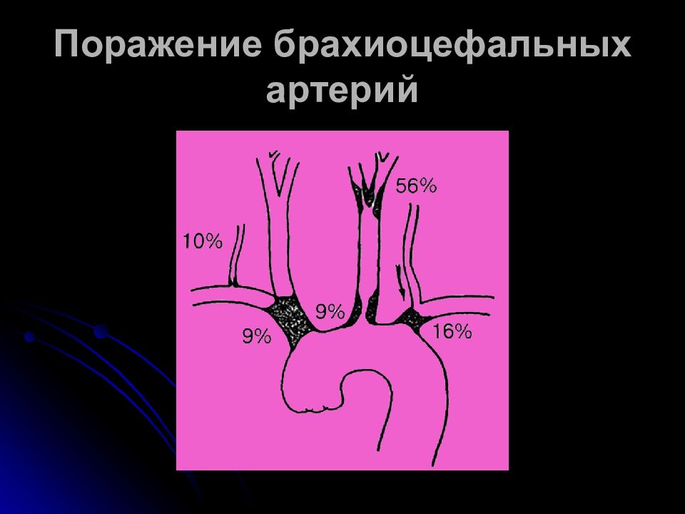 Брахиоцефальные артерии это. Брахиоцефальные артерии. Бронхоцеальные артерии. Брахиоцефальные сосуды. Заболевания брахиоцефальных артерий.