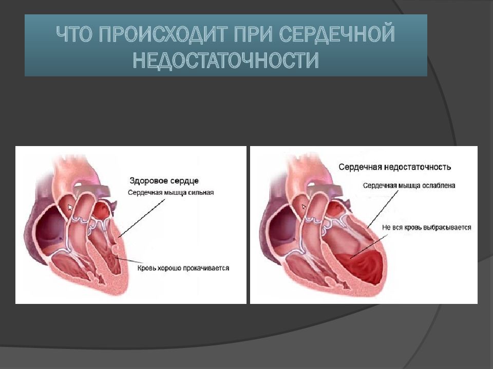 Острая сердечная недостаточность картинки для презентации