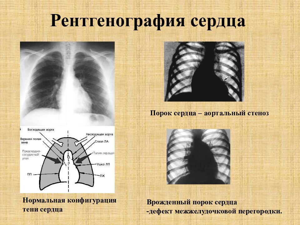 Рентген сердца. Аортальная конфигурация рентген. Аортальная конфигурация сердца рентген. Аортальный порок сердцаренген.