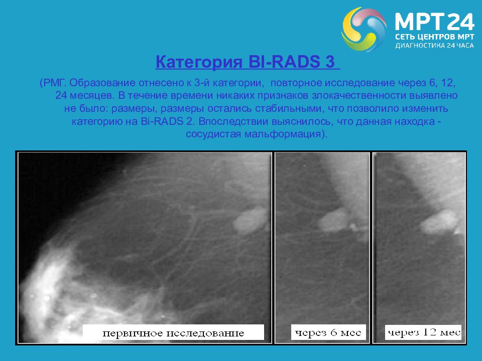 Диффузная мастопатия bi rads 2. Маммография молочных желез ACR 3 birads 1. Фиброзно-кистозная мастопатия маммография bi-rads. Фиброзно-кистозная мастопатия bi-rads 2. Классификация образований молочной железы.