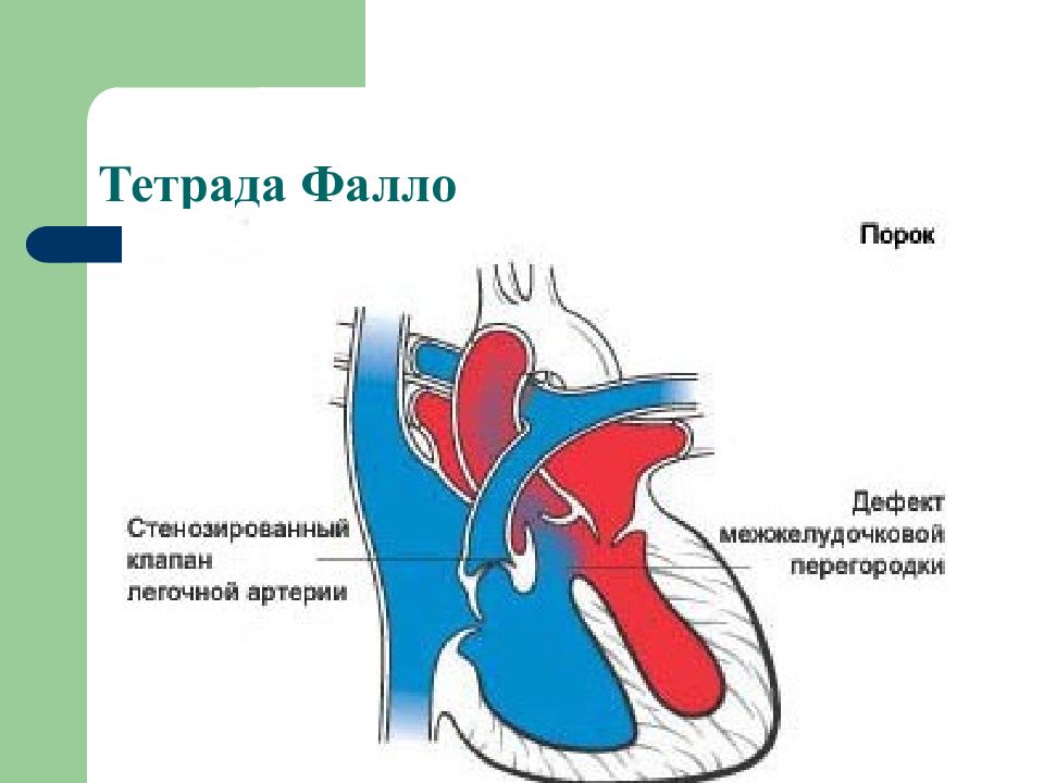 Порок тетрада фалло