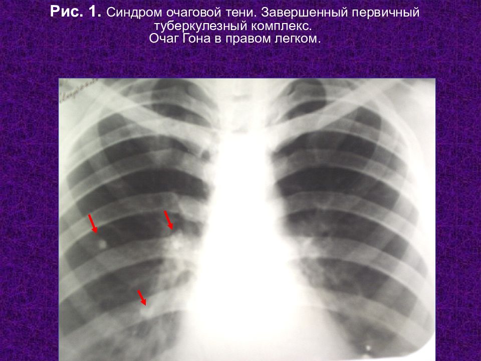 Гон легких. Первичный туберкулезный комплекс очаг гона. Очаг гона в легких фтизиатрия. Очаговый туберкулез очаг гона рентген.