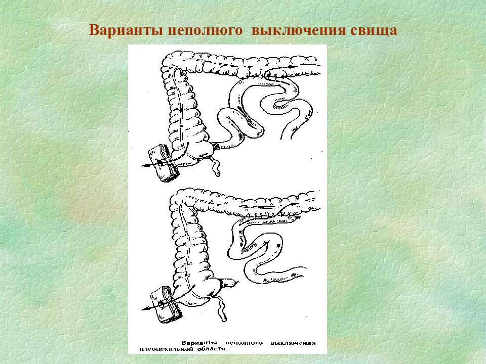 Кишечный свищ. Операция выключения кишечного свища. Неполный кишечный свищ. Неполное выключение свища.