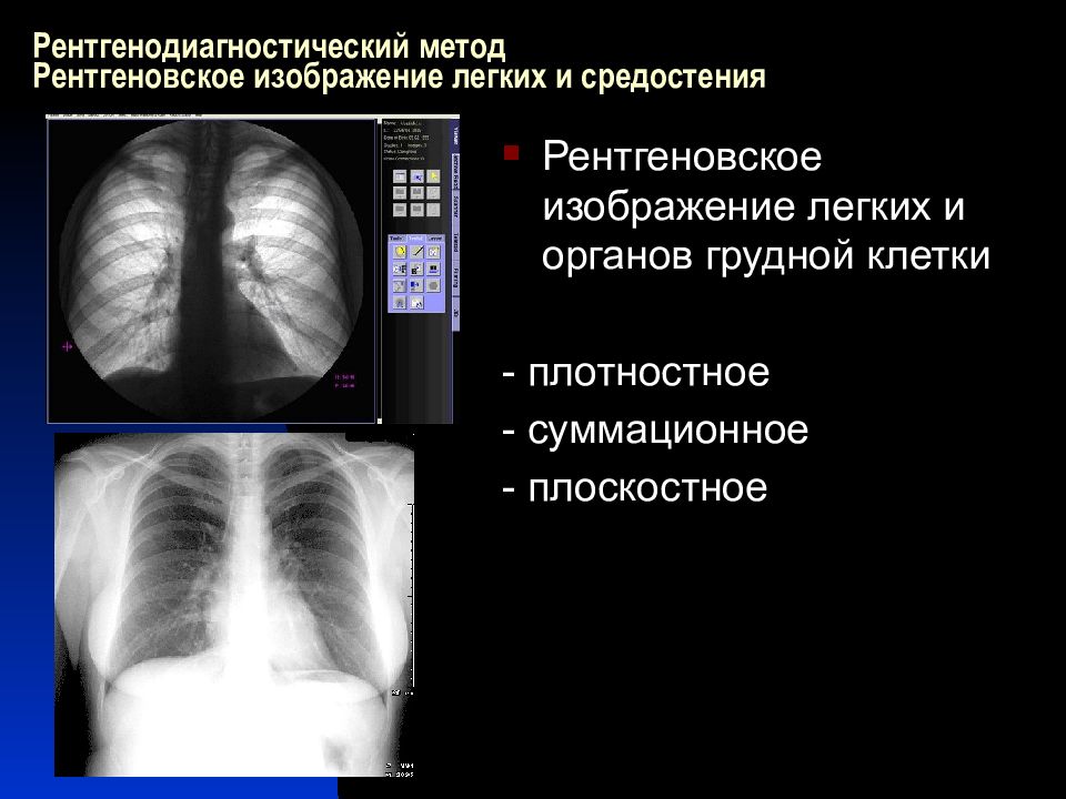 Лучевая диагностика органов средостения презентация