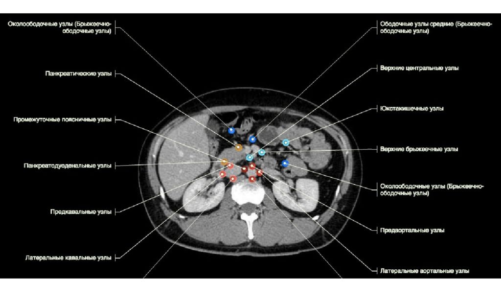 Латеральная ножка надпочечника. Кт анатомия органов брюшной полости. Лимфатические узлы брюшной полости кт. Лимфатические узлы брюшной полости на кт анатомия. Брюшная полость мрт анатомия.