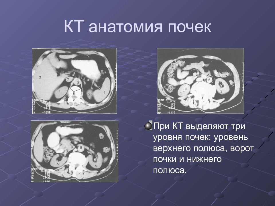 Лучевая диагностика почек презентация