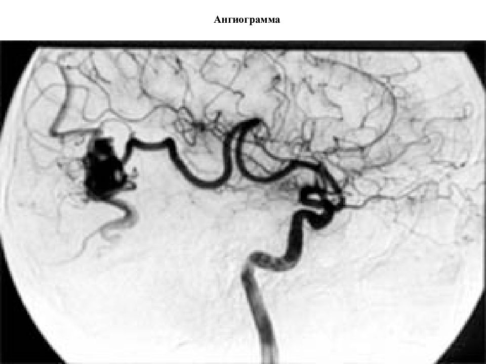 Сосудистые мальформации головного. Артериовенозные мальформации сосудов головного мозга. Мальформация сосудов на ангиографии. Мальформация аневризма. Артериовенозные мальформации на ангиографии.