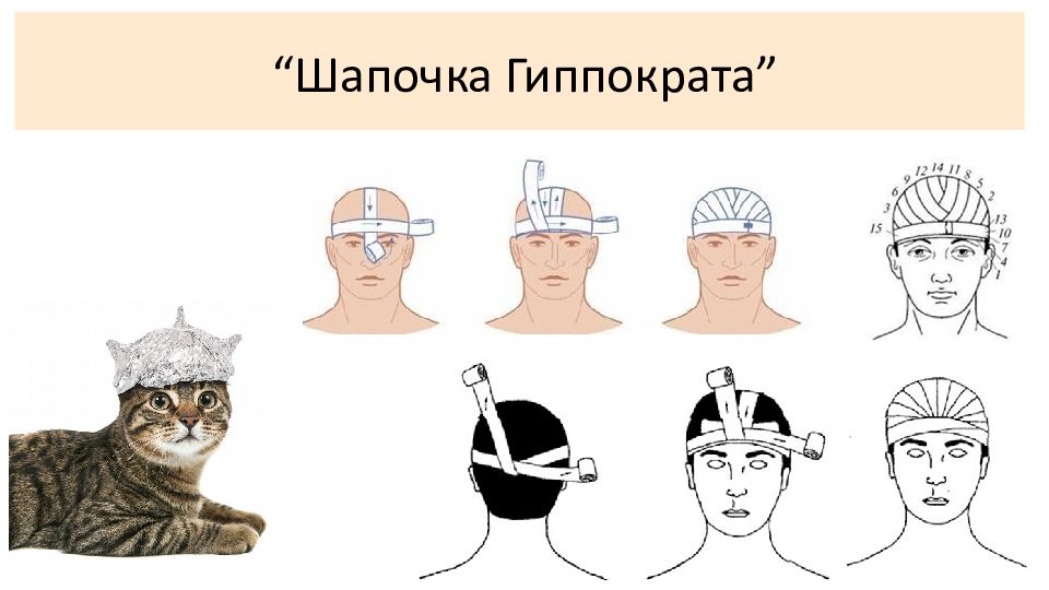 Повязка гиппократа. Десмургия шапочка Гиппократа. Десмургия шапка Гиппократа. Мягкие повязки шапка Гиппократа. Перевязка шапочка.