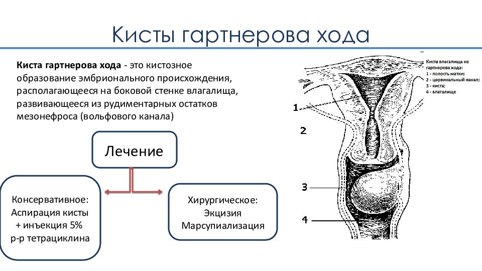 Киста гартнерова хода фото