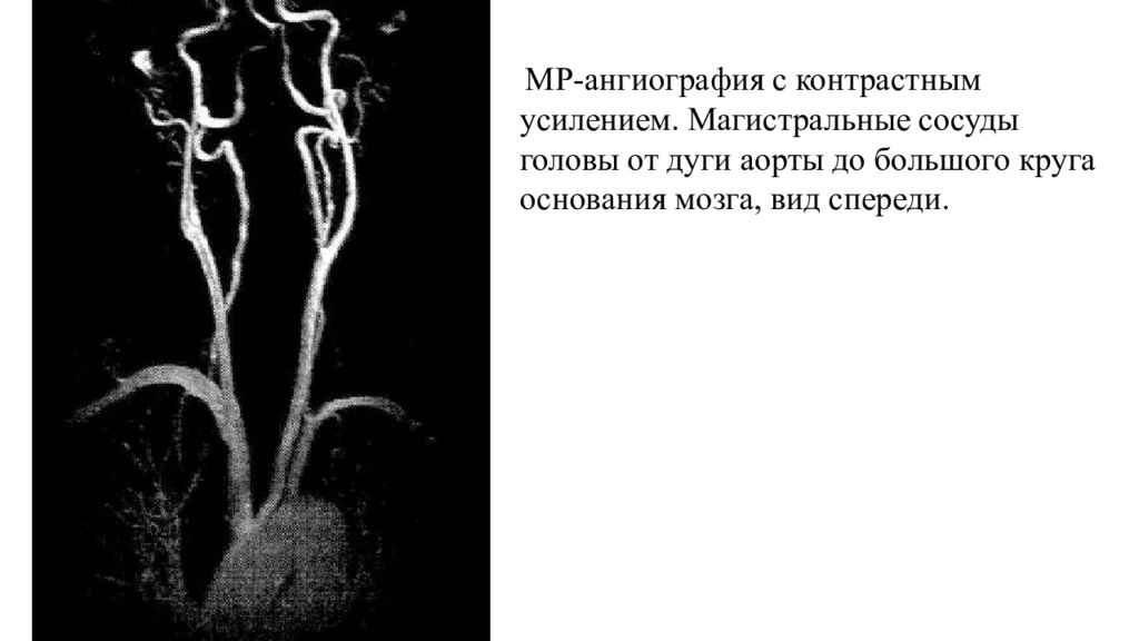 Контрастная ангиография. Ангиография дуги аорты. Магистральные артерии мозга. Магистральные сосуды головы. Магистральные сосуды дуги аорты.