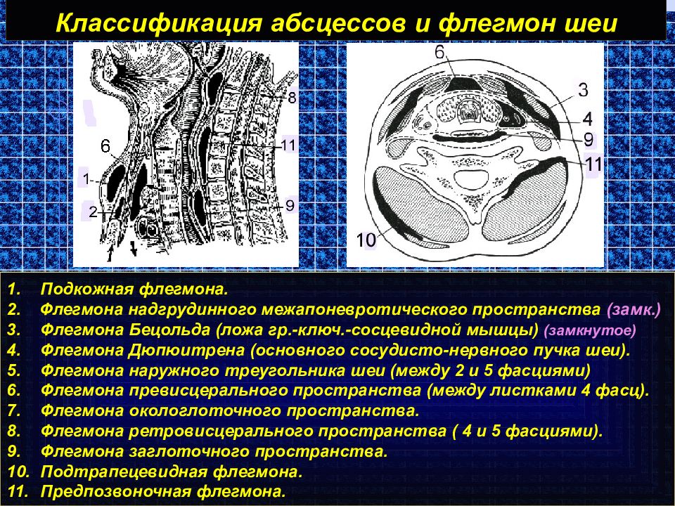 Пространства шеи. Флегмона клетчаточного пространства шеи. Флегмоны шеи классификация. Абсцессы и флегмоны шеи классификация.