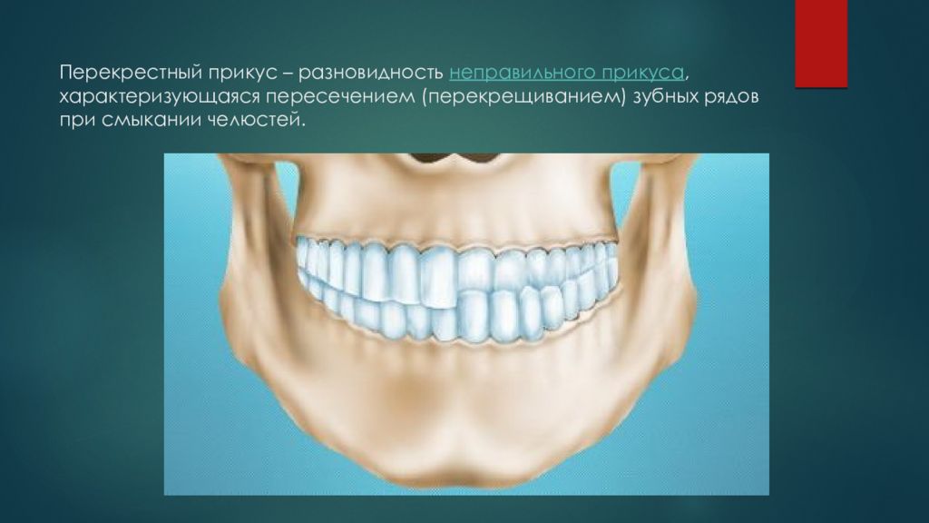 Перекрестный. Буккальный перекрестный прикус. Буккально-лингвальный перекрестный прикус. ВНЧС перекрестный прикус. Буккальная перекрестная окклюзия.