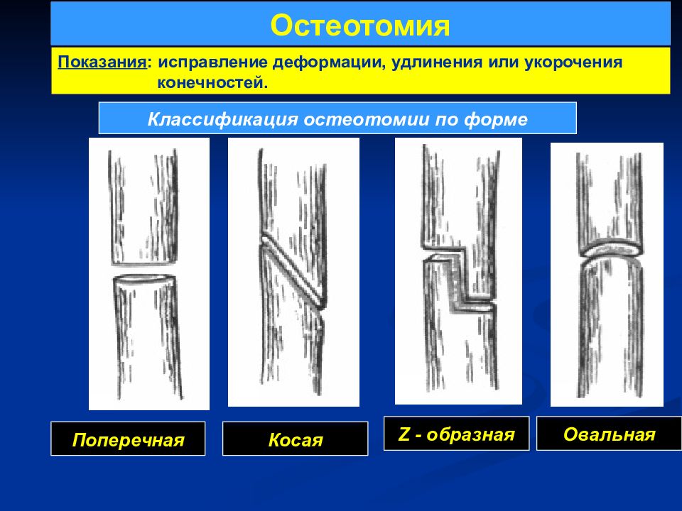 Укорочение трубчатых. Виды остеотомии. Остеотомия классификация. Поперечная остеотомия. Операции на костях. Остеотомия.