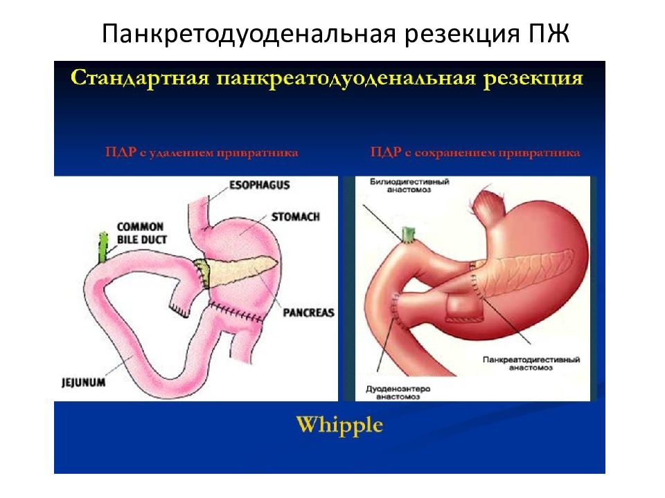 Резекция поджелудочной железы схема