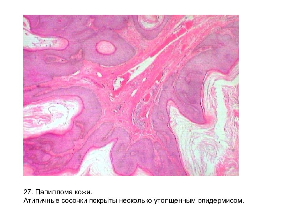 Микропрепарат папиллома кожи рисунок