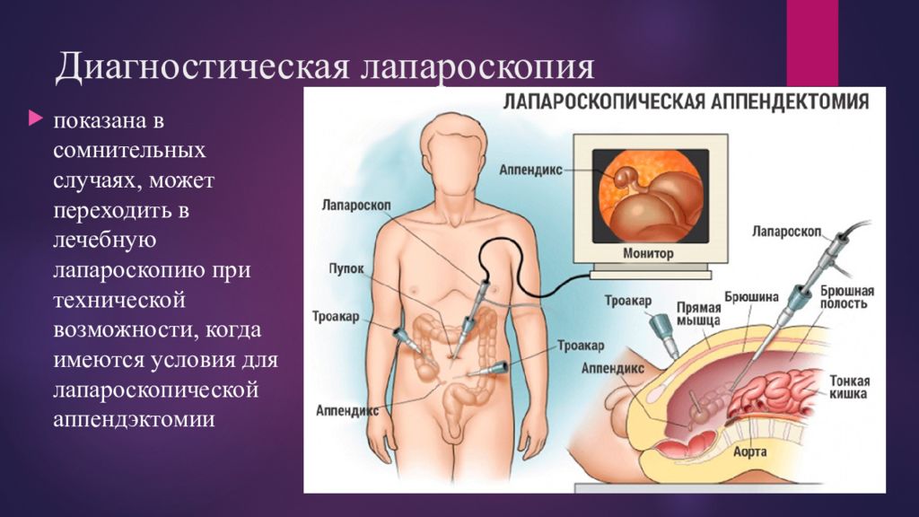 Осложнения аппендицита. Лапароскопия аппендикса. Осложнения операции аппендэктомии. Возможное осложнение аппендицита.