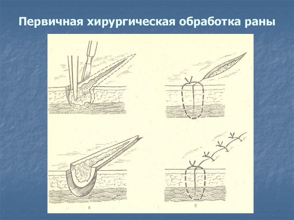 Раны пхо ран. Первичная хирургическая обработка РАН челюстно-лицевой области. Первичная хирургическая обработка ЧЛО. Пхо и вхо в хирургии.