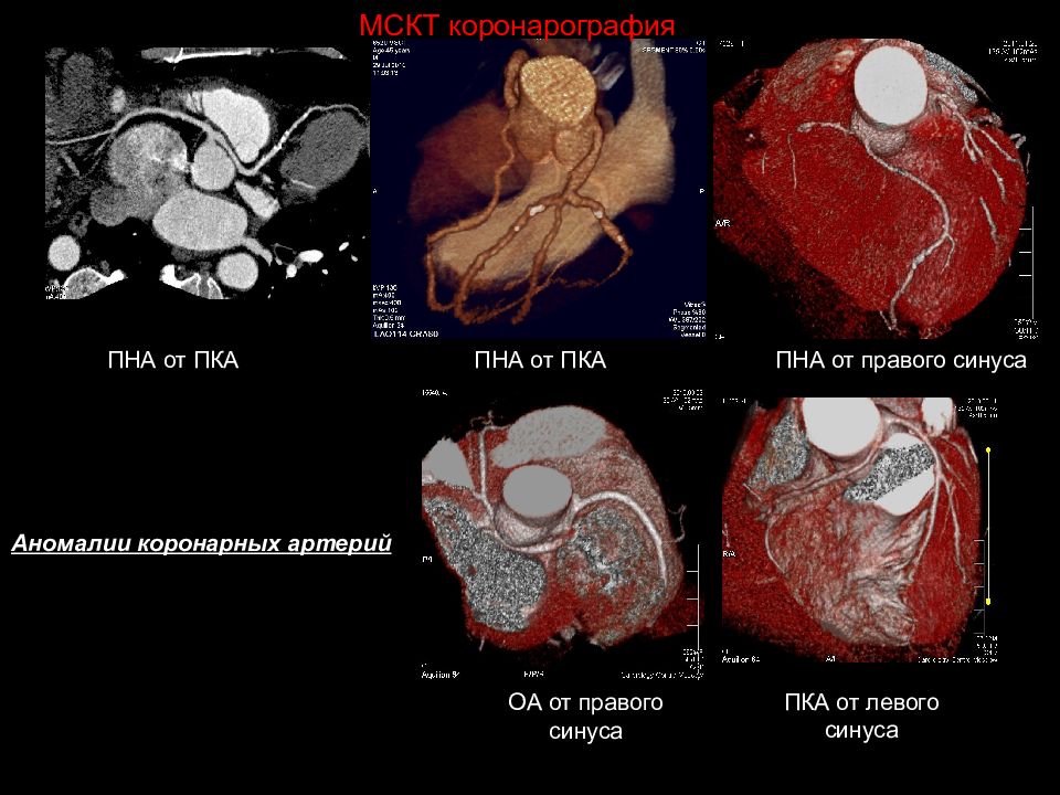Пна. Мультиспиральная компьютерная томография (МСКТ) коронарных артерий. Мультиспиральная компьютерная томография коронарография. Аномалия отхождения коронарных артерий от синуса. Мультиспиральная кт коронарных сосудов.